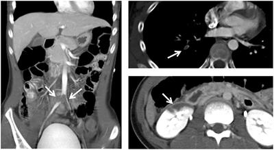 Childhood Nephrotic Syndrome Complicated by Catastrophic Multiple Arterial Thrombosis Requiring Bilateral Above-Knee Amputation